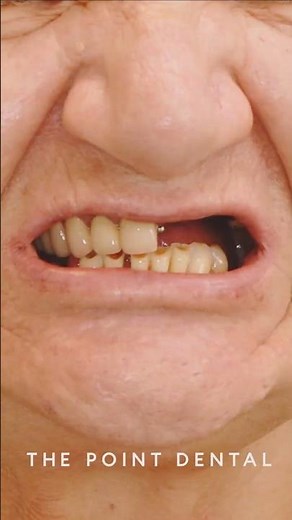 This Is Why She's Smiling Again #dentist #shorts #short #allon4dentalimplants #allon4 #smilemakeover