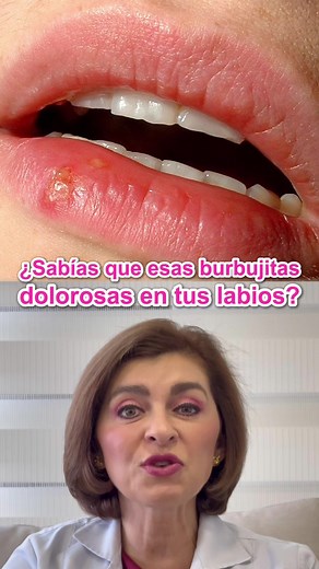 🧠 ¿Sabías que esas burbujitas dolorosas en tus labios NO se curan con cremas? Lo que muchos creen que es solo una irritación, en realidad es herpes labial, un virus que vive dormido en tus nervios y despierta con el estrés, la fiebre o incluso el sol 🌞. 🔥 Aprende a detenerlo antes de que aparezca: ✔️ Actúa apenas sientas el escozor o ardor. ✔️ Usa un antiviral oral recetado (como aciclovir). ✔️ Refuerza tus defensas con vitamina C y D. 💊 No gastes más en cremas que solo disimulan el problema