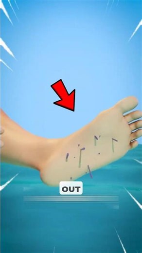 DO NOT pull out Sea Urchin Spines! 😱