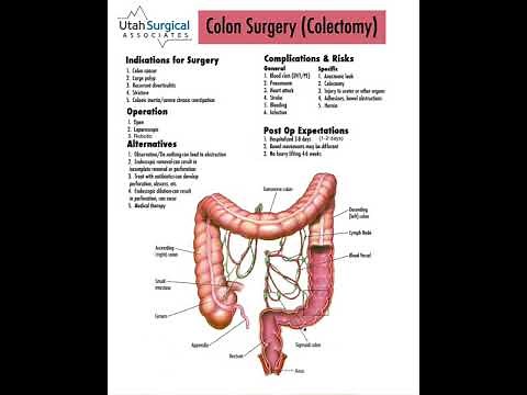 Removing part of the colon