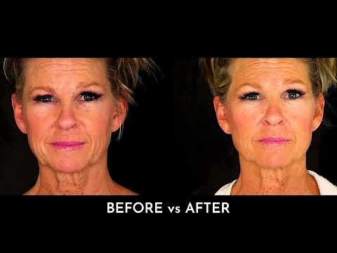 Mini FaceLift Performed by Dr. Pryor in Rockford, IL