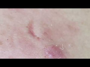 Make your Acne Treatment Dr. Thuy Truong #507 | acne 2023
