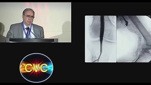 Identifying Femoral and Popliteal Aneurysms and Choosing the Appropriate Treatment Options
