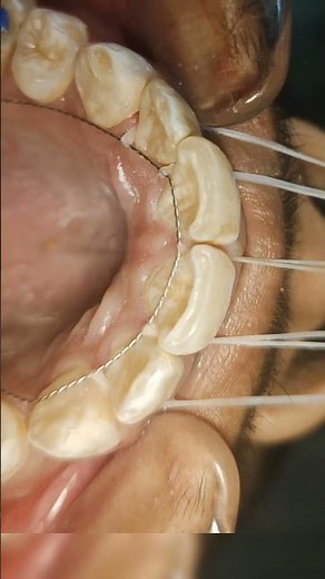 trick to hold a lingual retainer #dentist #orthodontist #satisfying #real