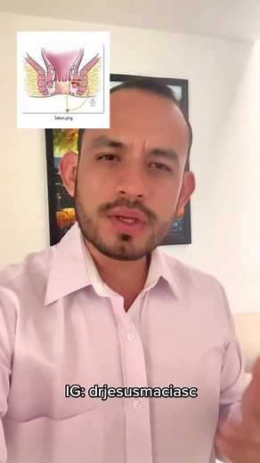 Qué es el Seton? Técnica para Tratamiento de Fístulas Perianales