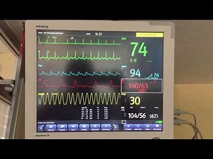 Monitoreo hemodinámico