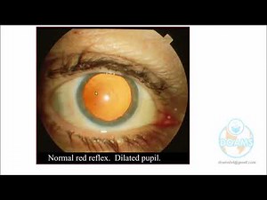 Fundoscopy for Beginners