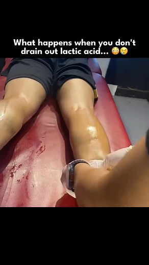Lavia Health | Lactic acid drainage 🤯 Media: dr.mohamedabdelaziz on tiktok Please note: This is not intended as medical advice, diagnosis or treatment.... | Instagram