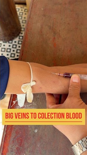 Big veins to colection blood #youtubeshorts #shortvideo #bloodcollection #nurse #process #iv