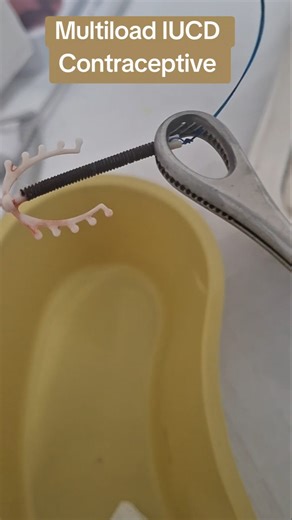 Contraceptive Device Removal..Multiload IUCD #iucd #contraceptives #contraception #familyplanning#yt