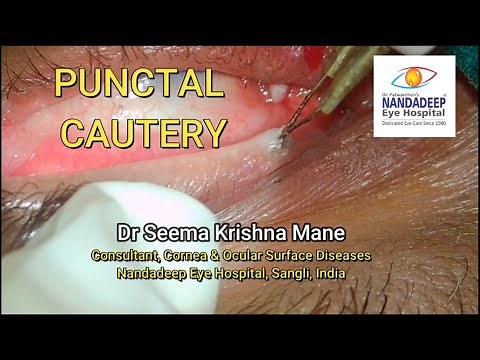 How to do Punctal cautery : Dr Seema Mane (Indications and procedure)