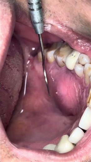 Tooth Abscess Treatment | Dental Procedure Close-Up