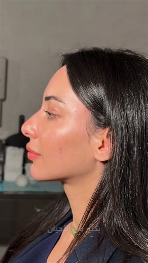 ‎Dr. Lyn Alamy | د. لين العلمي‎ on Instagram‎: "التجميل الصح مو إنو نغيّر الملامح… التجميل الصح إنو نفهم التشريح، ونحترم المعالم، ونخلّي كل وجه يطلع أجمل نسخة من نفسو 🤍 If it doesn’t respect anatomy, it’s not aesthetic medicine 😉 #drlynalamy #dubai #dubai🇦🇪 #beauty #askaderm"‎