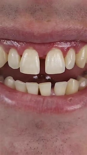 midline diastema closure with composite #dentist #shorts
