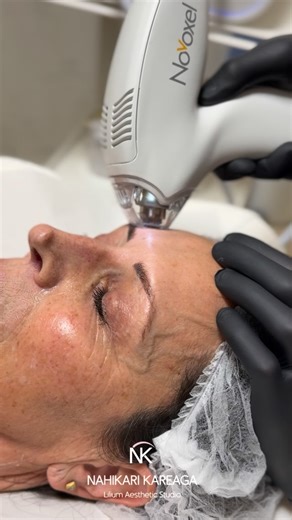 Clinica Nahikari Kareaga Lilium Aesthetic Studio on Instagram: "✨ TIXEL Full Face ✨ rejuvenecimiento premium, sin perder tu naturalidad. Si notas arrugas, párpados más caídos, textura apagada o esa sensación de “mi piel ya no responde”… este tratamiento es para ti. En Lilium Aesthetic Studio trabajamos el TIXEL full face con tecnología médico-estética TMA (Thermo-Mechanical Ablation), para activar tu piel desde dentro: ✔️ mejora arrugas finas y medias ✔️ reafirma los párpados caídos ✔️ afina por