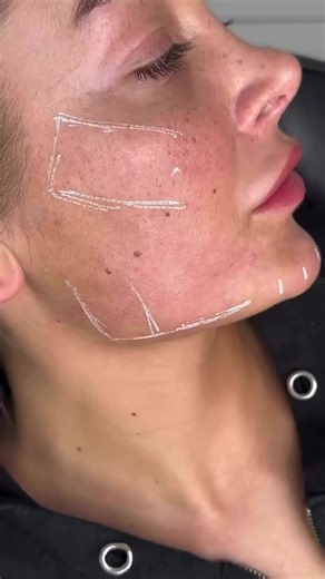 ✨ The Aesthetics Therapy – Your Secret to Timeless Beauty in London ✨ Discover the Magic: 💉 Anti-Wrinkle Injections – Smooth lines, keep your glow 💋 Dermal Fillers – Plump lips, sculpt cheeks, define jawlines & tear troughs 🧵 PDO Thread Lifts – Instant lift for face, neck & body (no knives, no scars) 🔥 Fat-Dissolving Injections – Melt stubborn pockets, reveal your contours 🌊 Polynucleotides & Skin Boosters – Hydrate, heal, regenerate from within 👃 Non-Surgical Rhinoplasty – Refine your pro