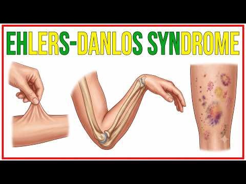 92. Ehlers-Danlos Syndrome | Hypermobile Joints, Skin Hyperextensibility & Management | Pediatrics