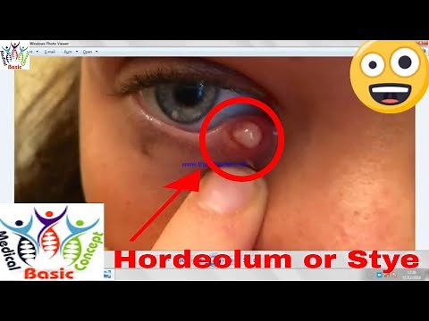 Hordeolum externum OR Stye on Eyelid & Hordeolum internum with Treatment - Eye(Ophthalmology)