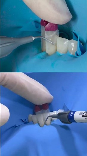 Carillas de Composite Inyectado en el Sector Anterior e Introducción al Método Bioclear