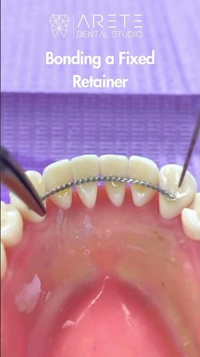 Bonding a Fixed Retainer
