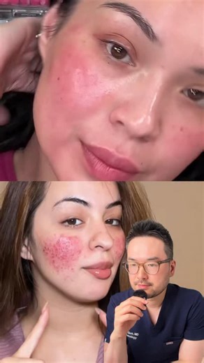 Dr. Danny Guo on Instagram: "Why your rosacea cream isn’t working? It’s probably because you are treating the wrong type 🥲 #dermatologist #skincare"
