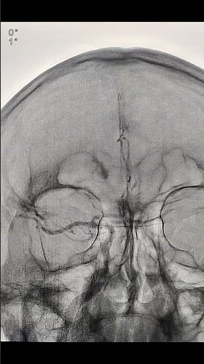 3 D Cerebral Angiography ( 4 vessel Angiography )
