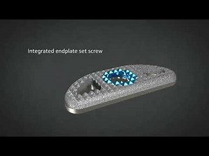 Alphatec Spine: ATEC PTP™ Corpectomy