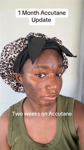 One Month Accutane Journey: Results and Insights