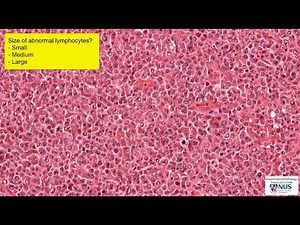 Lymph node: Large cell lymphoma microscopy - Talking Slide