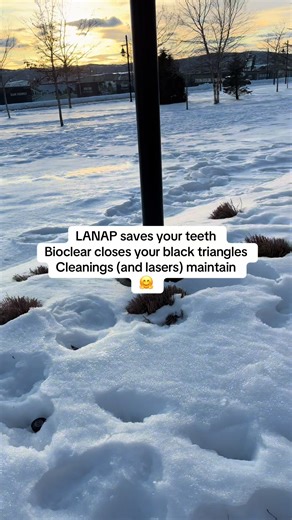 And in a couple of months, we’ll have Pinhole Technique to restore your gumline 💙 #minimallyinvasive #dentalcare #oralcare #teethcare #oralhygiene