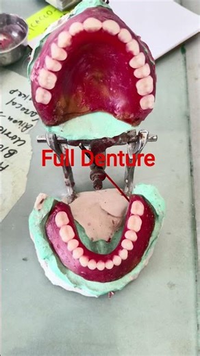 Full Denture | #dentaltreatments #trending #viralvideo