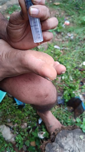 Easy Splinter Removal Hack Using a Syringe! 🩹#youtubeshorts #shorts