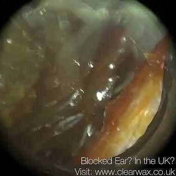 425 - Ear Wax Removal using the WAXscope®️