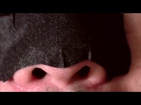 Nose Full Of Blackheads. Blackheads Removal With Pore Strips.
