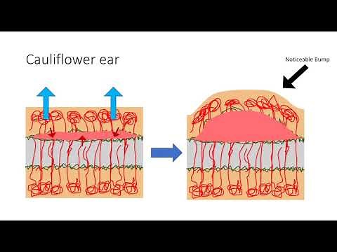 What is Cauliflower Ear