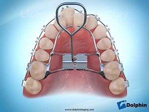 Do you know the benefits of an EXPANDER? An RPE (Rapid Palatal Expander) is used to widen the upper jaw so that the bottom and upper teeth will fit together better. Although the use of an expander is most common in children it can be, and has successfully been used, in adults. The expansion process usually results in a large gap between the patient's 2 top front teeth, although this does not always happen. This gap is closed naturally and the teeth may overlap which leads to braces being needed.