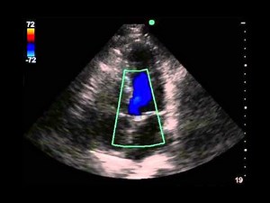 Echo Appearance of Aortic Regurgitation or Insufficiency