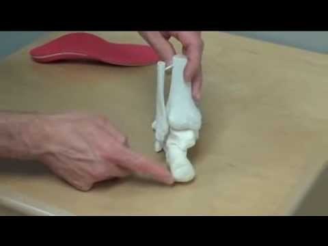 Supinated Foot - Foot Orthotic