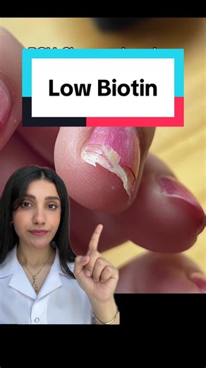 Signs of Low Biotin and How to Increase Levels