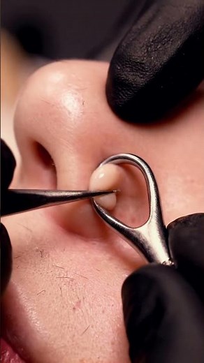 Nose Comedone Extraction | Extreme Macro 4K #macroasmr #satisfying #macroextraction