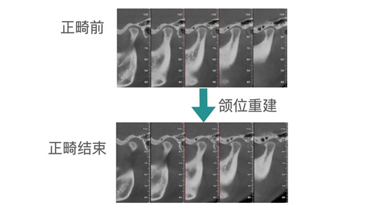 DOB颌位重建No.5: 伴不可复 骨关节病的磨牙远中深覆合的颌位重建正畸治疗