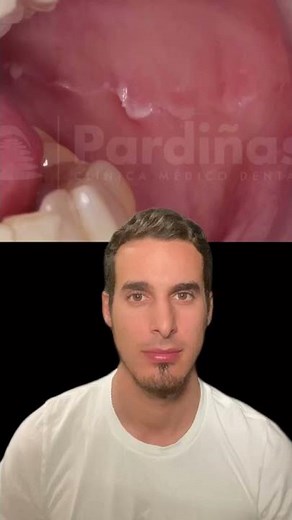 Linea alba around the mouth - Why does it appear and how to get rid of it?