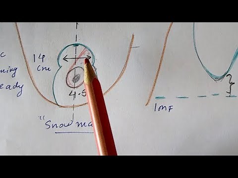 Vertical pattern superomedial pedicle breast reduction