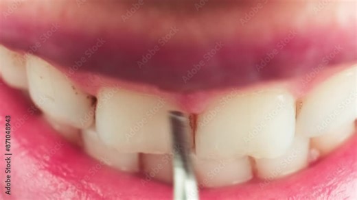 Close-up of teeth cleaning and calculus removal using an electric tool. Professional dental care