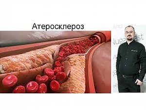 Атеросклероз - лекция доктор Голода