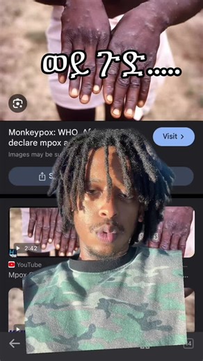 Understanding Monkeypox: Symptoms and Public Health Impact