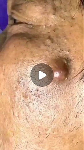 MyCern Beauty & Anti-Aging on Instagram: "Follow us for more pimple popping videos🥰 . . Credit: @satisfying.pimple.pops (Tik Tok) Disclaimer: No copyright infringement intended. All credit goes to the rightful owners. Please DM for credits or removal. . . #pimples #acne #skincare #blackheads #pimple #pimplepopping #whiteheads #acnetreatment #beauty #whitehead #blackhead #pimplepoppers #cyst #pores #skin #drpimplepopper #antiaging #pimplesremover #blackheadextraction #zits #pimplepop #skincarero