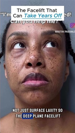 The Facelift That Can Take Years Off