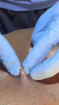 Rare condition of multiple oil-filled body cysts : steatocystoma multiplex #dermatology #cysts