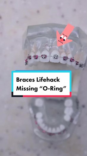 Braces Lifehack: How to Replace Missing O-Ring on Braces